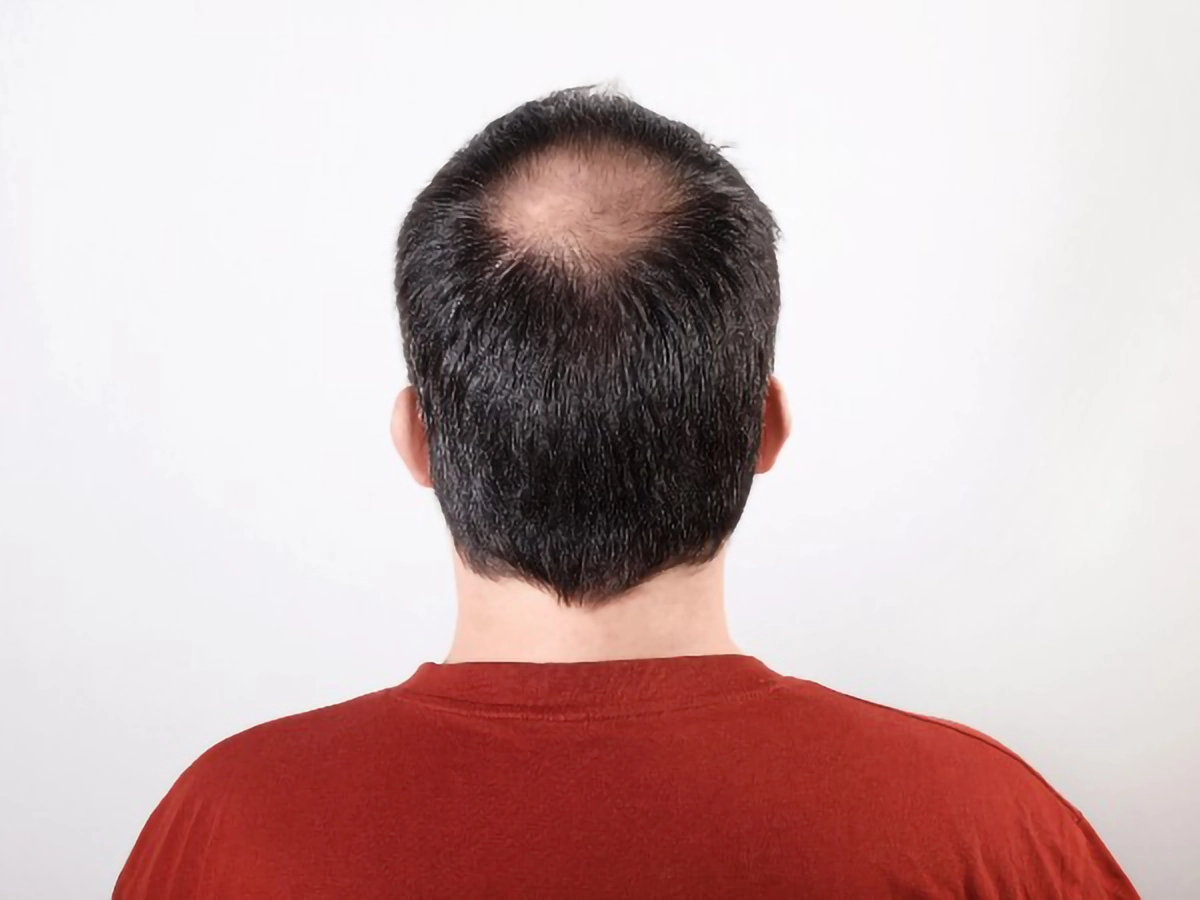 male-pattern-baldness